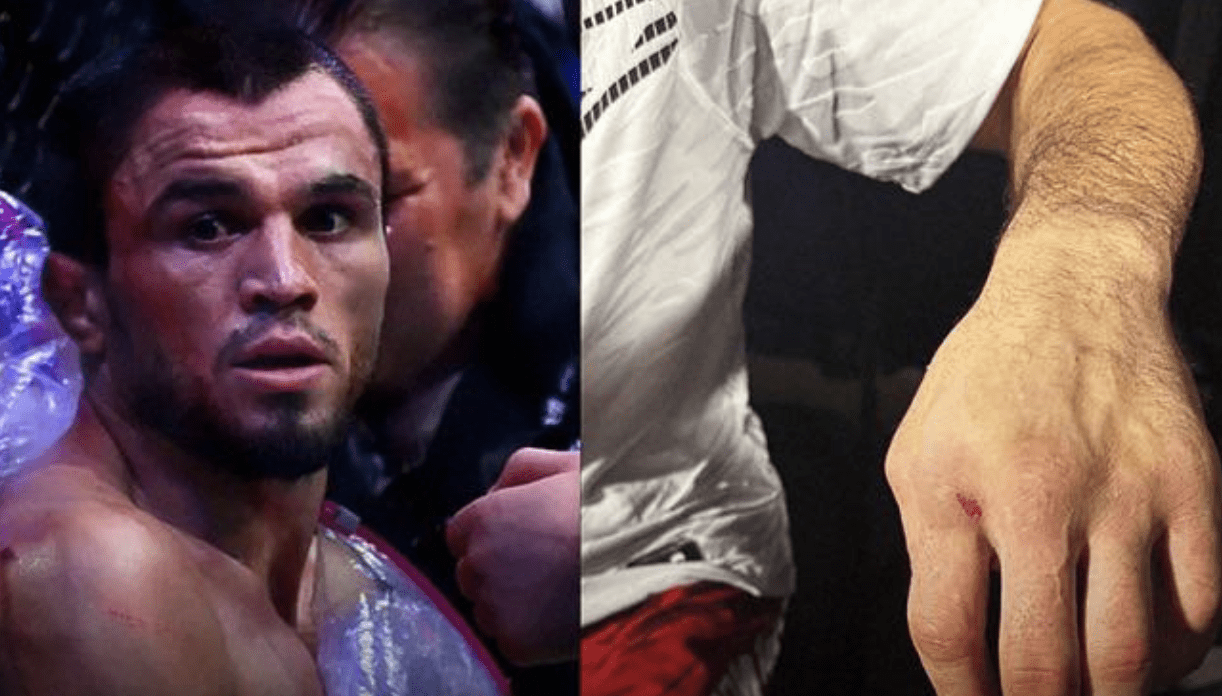 Umar Nurmagomedov's Hand Injury Fears; Could Be Out For Six Months
